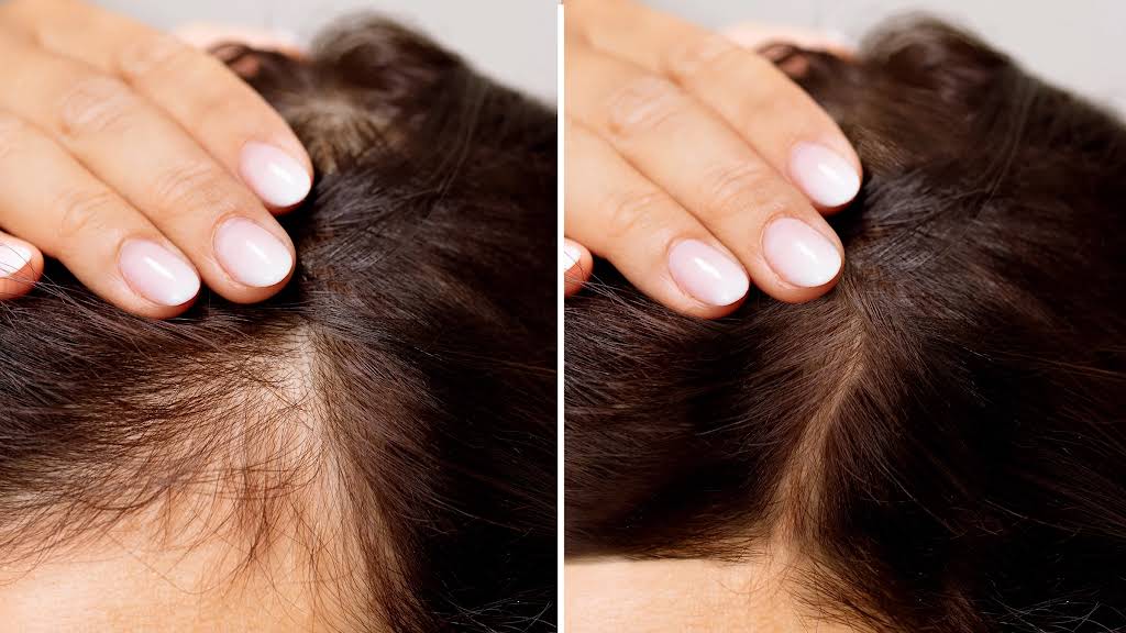Hair Growth